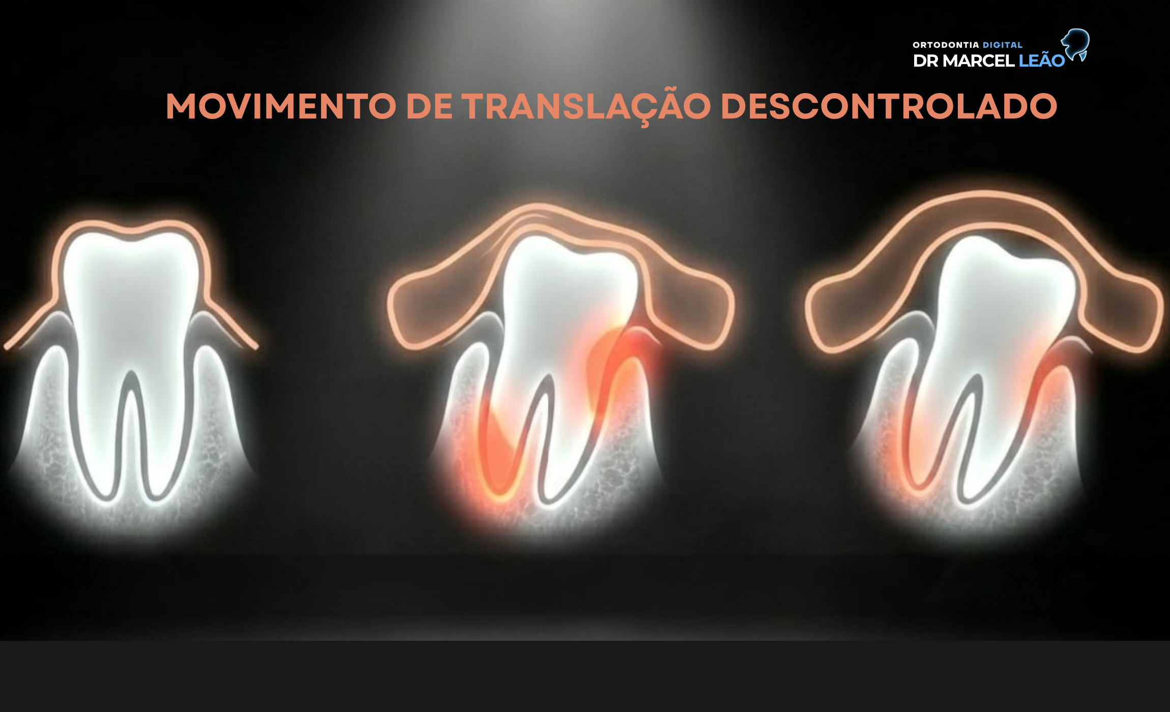 Movimento de inclinação coronária.