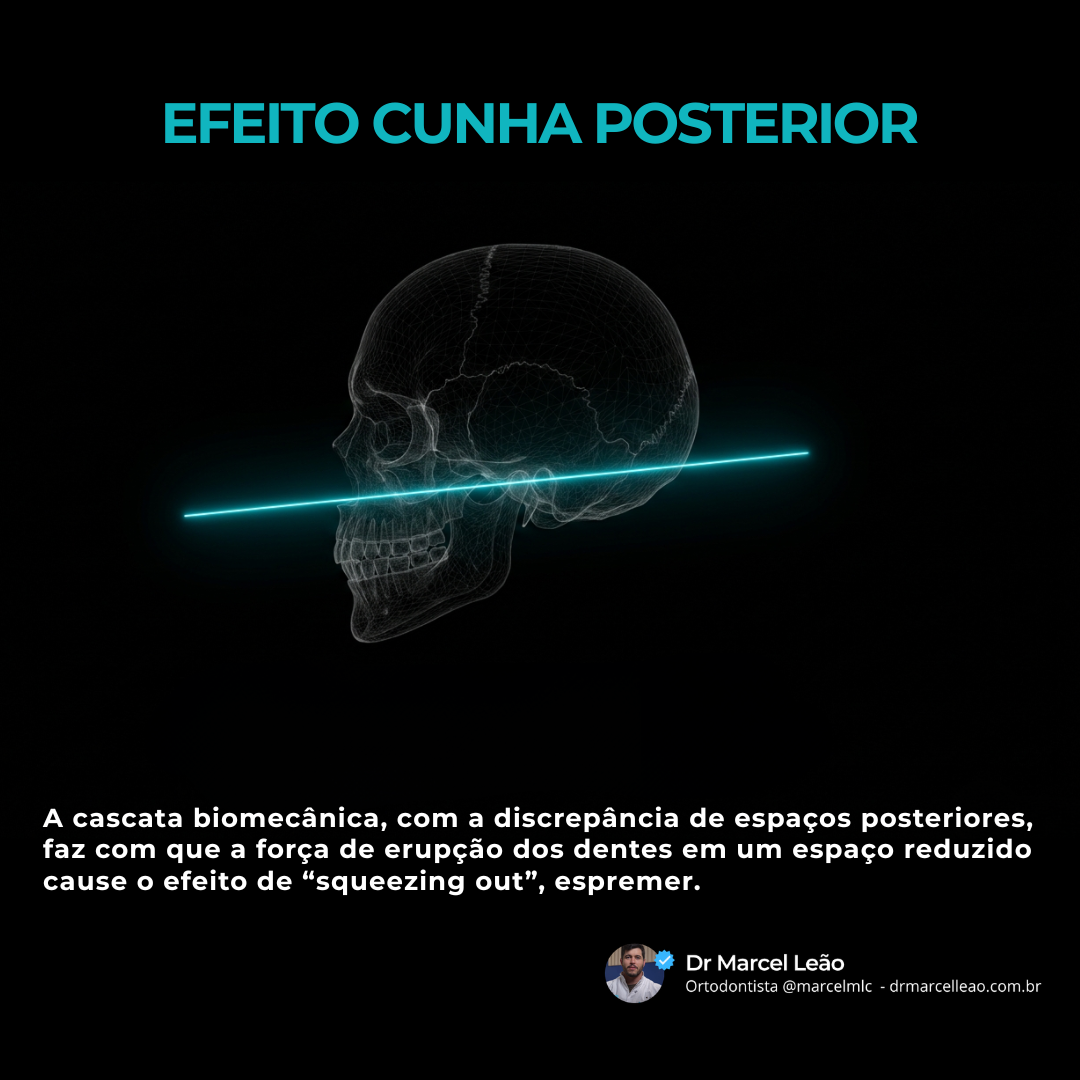 Formação do calço: esse processo gera uma sobre-erupção compensatória e um contato prematuro severo que altera o plano oclusal.